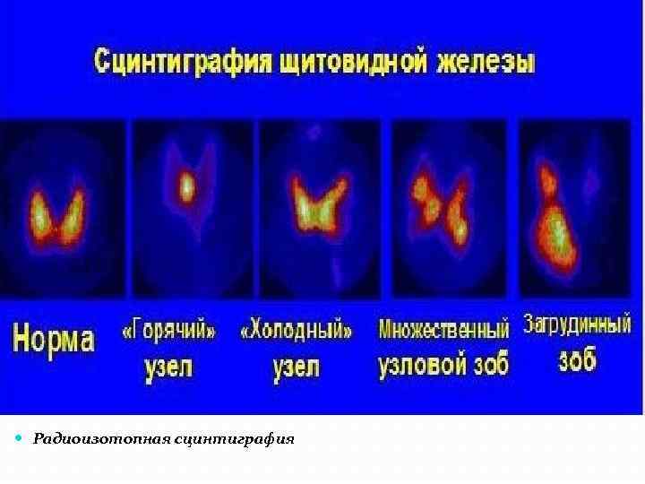 Сцинтиграфия щитовидной железы это