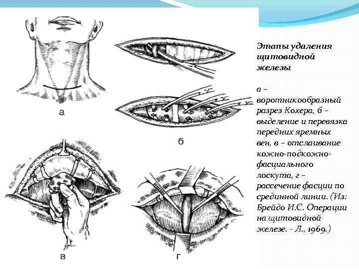 Удаление железа. Разрез по Кохеру к щитовидной железе. Резекция щитовидной железы по Кохеру. Субтотальная резекция щитовидной железы схема. Доступ кохера к щитовидной железе.