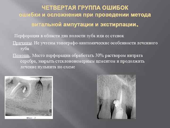 ЧЕТВЕРТАЯ ГРУППА ОШИБОК ошибки и осложнения при проведении метода витальной ампутации и экстирпации. Перфорация