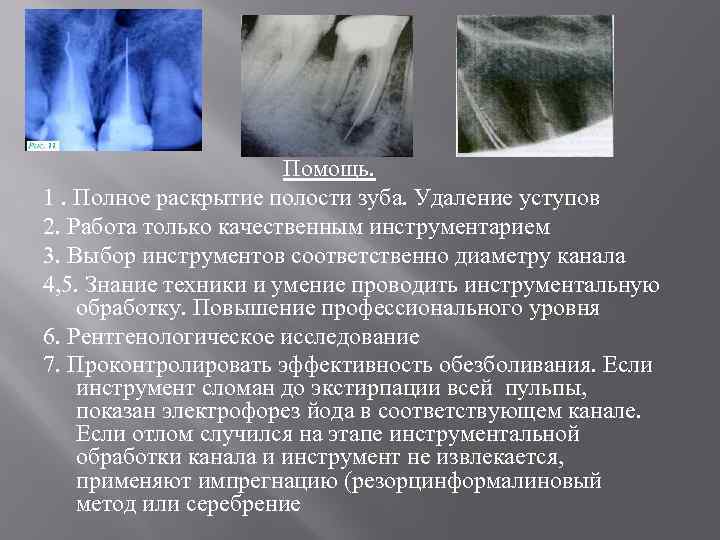 Ошибки и осложнения при диагностике и лечении кариеса презентация