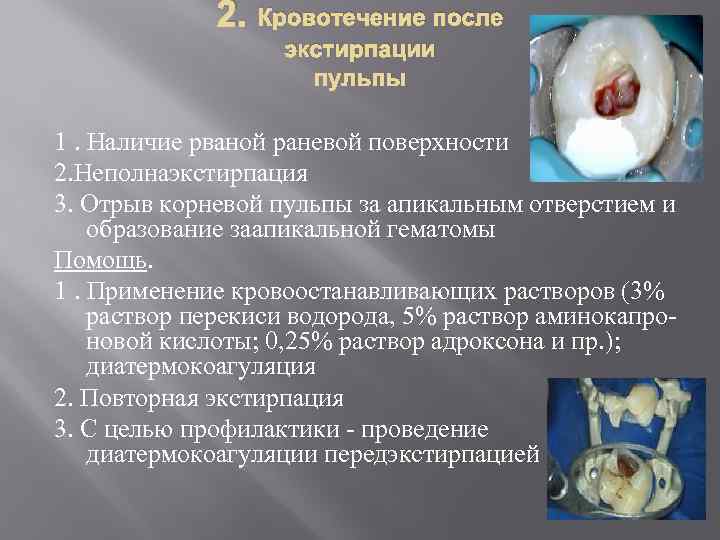 2. Кровотечение после экстирпации пульпы 1. Наличие рваной раневой поверхности 2. Неполнаэкстирпация 3. Отрыв