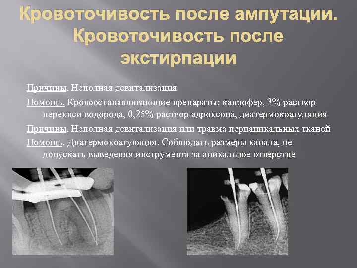 Ошибки и осложнения при диагностике и лечении пульпита презентация