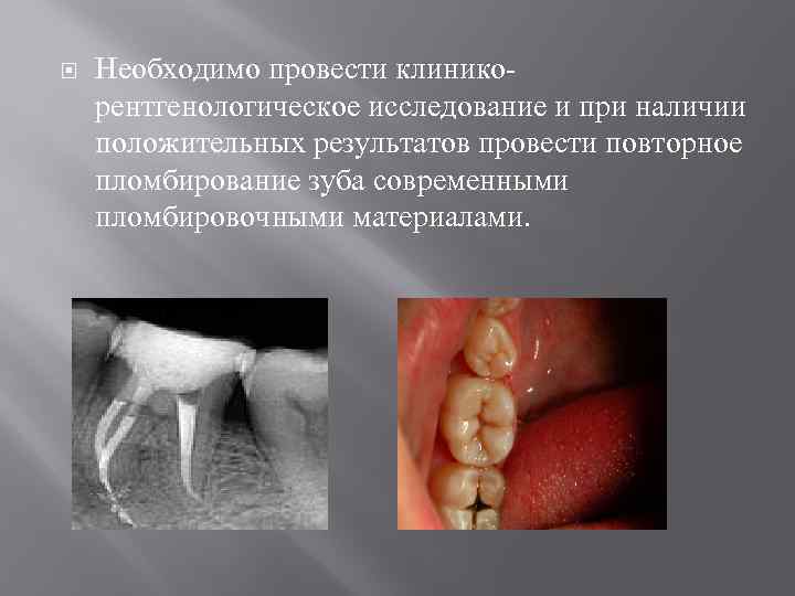  Необходимо провести клиникорентгенологическое исследование и при наличии положительных результатов провести повторное пломбирование зуба