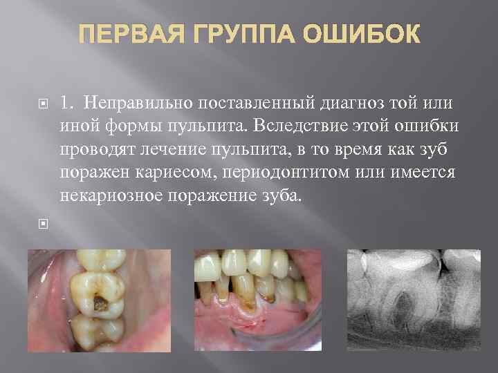 ПЕРВАЯ ГРУППА ОШИБОК 1. Неправильно поставленный диагноз той или иной формы пульпита. Вследствие этой