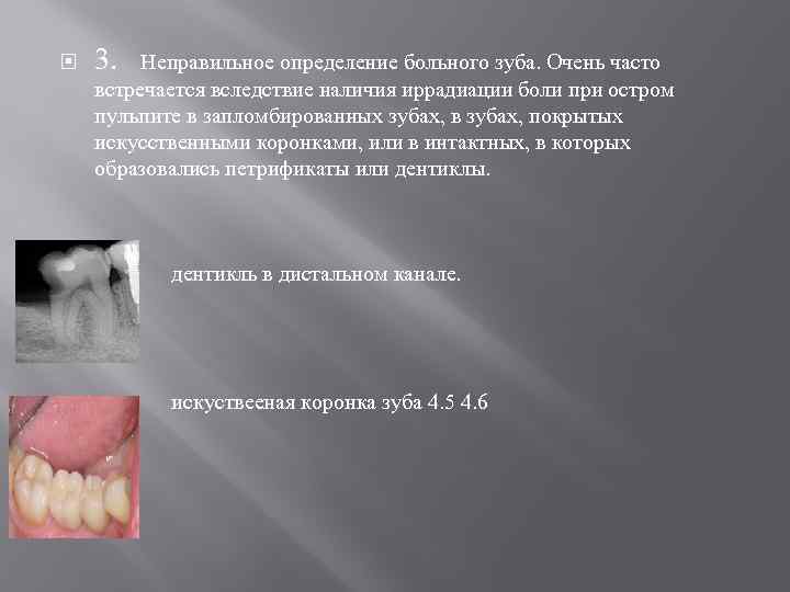  3. Неправильное определение больного зуба. Очень часто встречается вследствие наличия иррадиации боли при