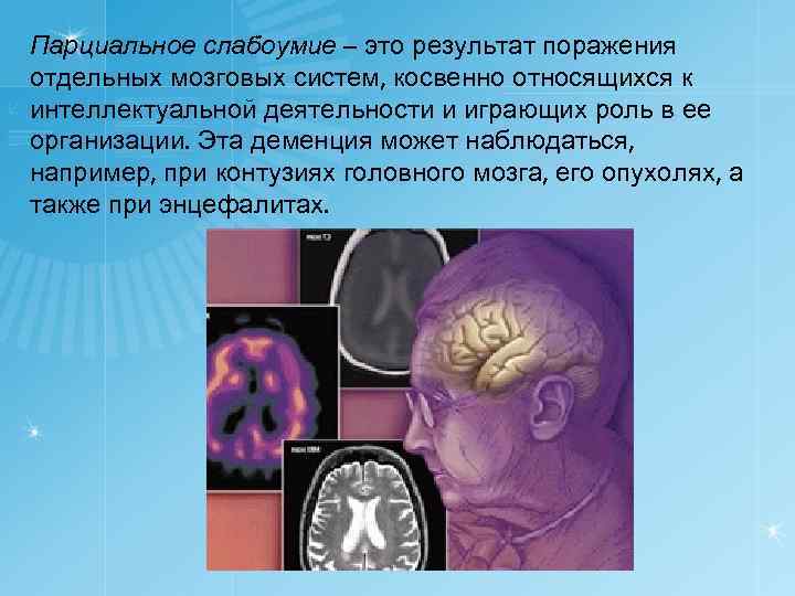 Временное слабоумие. Парциальное слабоумие. Парциальная деменция. Парциальная деменция головной мозг. Отек головного мозга при деменции.