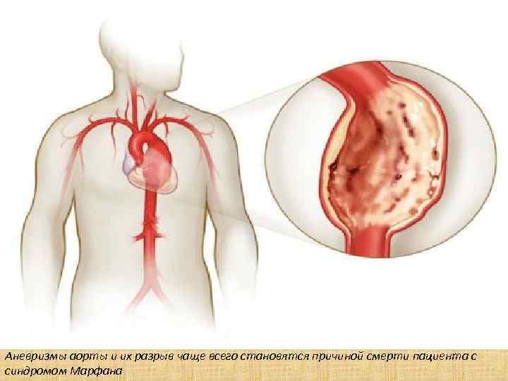 Аневризмы аорты и их разрыв чаще всего становятся причиной смерти пациента с синдромом Марфана