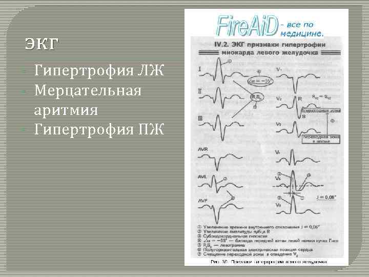 экг • • • Гипертрофия ЛЖ Мерцательная аритмия Гипертрофия ПЖ 