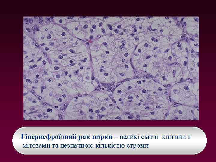 Гіпернефроїдний рак нирки – великі світлі клітини з мітозами та незначною кількістю строми 