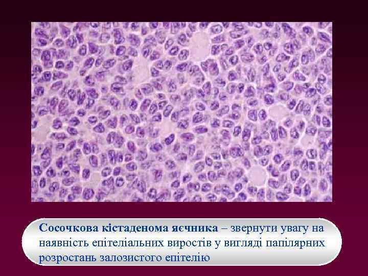 Сосочкова кістаденома яєчника – звернути увагу на наявність епітеліальних виростів у вигляді папілярних розростань