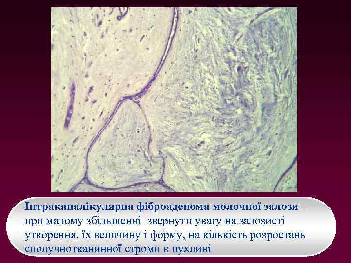 Інтраканалікулярна фіброаденома молочної залози – при малому збільшенні звернути увагу на залозисті утворення, їх