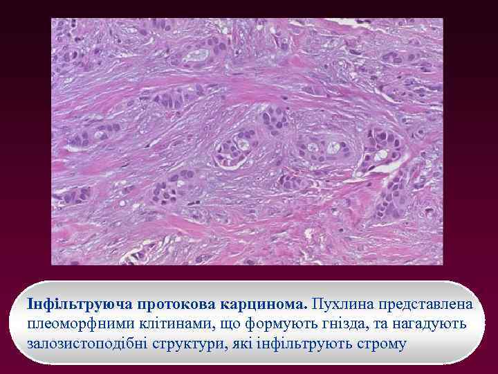 Інфільтруюча протокова карцинома. Пухлина представлена плеоморфними клітинами, що формують гнізда, та нагадують залозистоподібні структури,