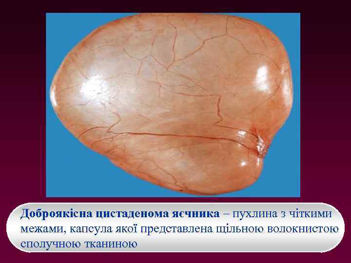 Доброякісна цистаденома яєчника – пухлина з чіткими межами, капсула якої представлена щільною волокнистою сполучною