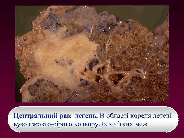 Центральний рак легень. В області кореня легені вузол жовто-сірого кольору, без чітких меж 