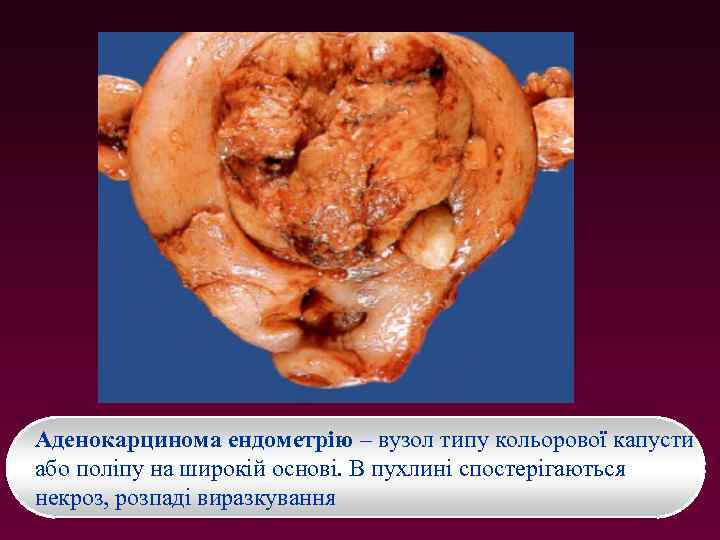 Аденокарцинома ендометрію – вузол типу кольорової капусти або поліпу на широкій основі. В пухлині