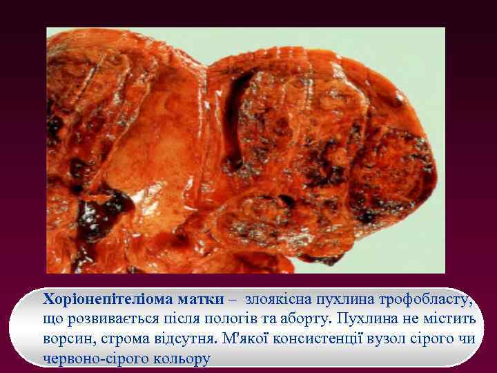 Хоріонепітеліома матки – злоякісна пухлина трофобласту, що розвивається після пологів та аборту. Пухлина не