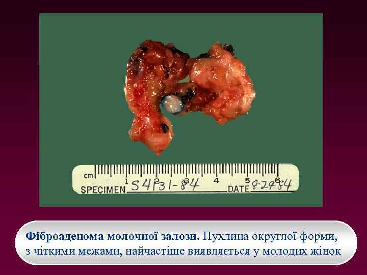Фіброаденома молочної залози. Пухлина округлої форми, з чіткими межами, найчастіше виявляється у молодих жінок