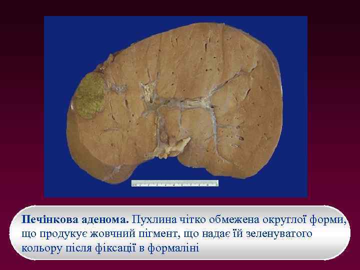 Печінкова аденома. Пухлина чітко обмежена округлої форми, що продукує жовчний пігмент, що надає їй