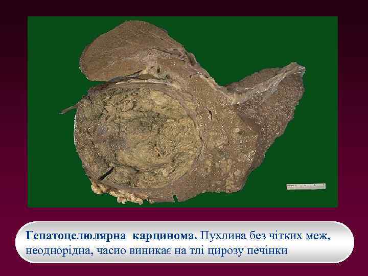 Гепатоцелюлярна карцинома. Пухлина без чітких меж, неоднорідна, часио виникає на тлі цирозу печінки 