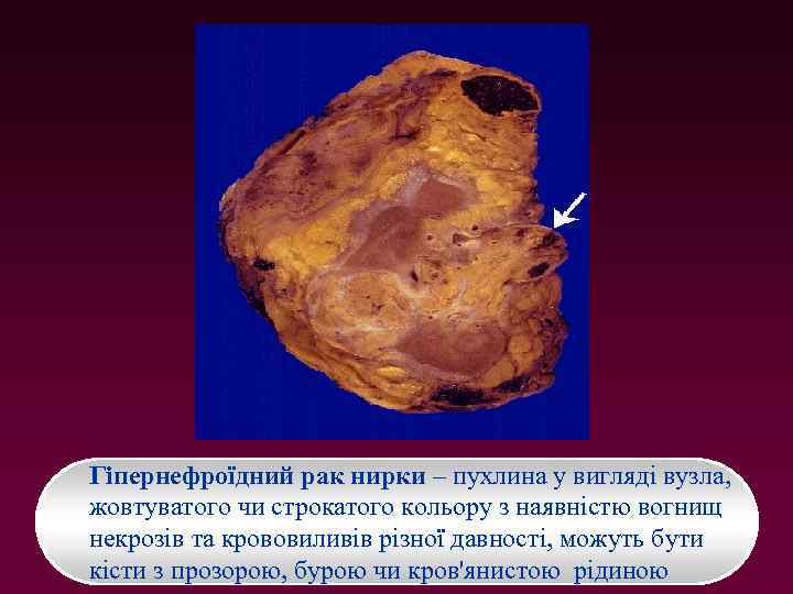Гіпернефроїдний рак нирки – пухлина у вигляді вузла, жовтуватого чи строкатого кольору з наявністю