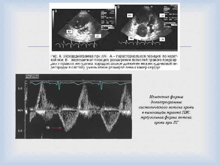  Изменение формы допплерограммы систолического потока крови в выносящем тракте ПЖ: треугольная форма потока