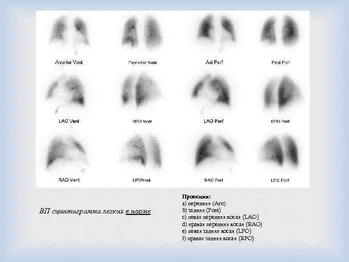  ВП сцинтиграмма легких в норме Проекции: а) передняя (Ant) б) задняя (Post) с)