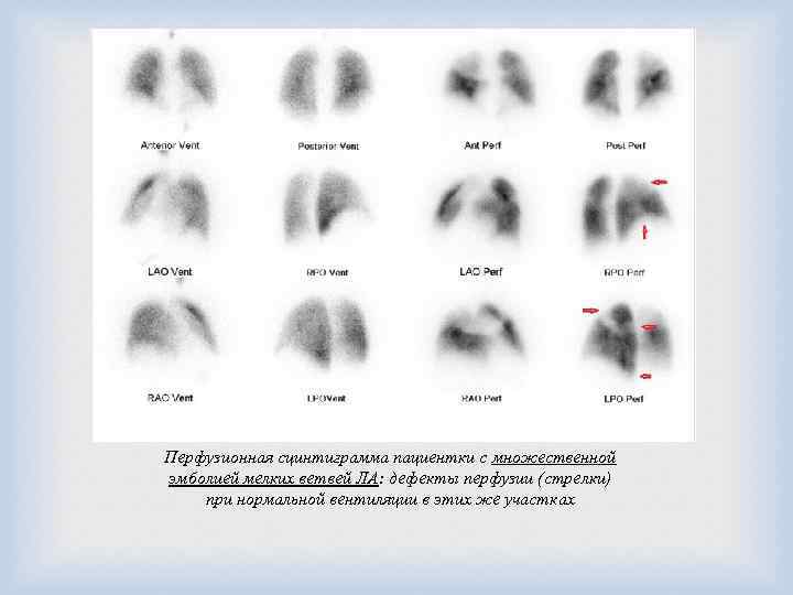  Перфузионная сцинтиграмма пациентки с множественной эмболией мелких ветвей ЛА: дефекты перфузии (стрелки) при