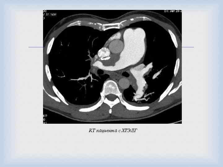  КТ пациента с ХТЭЛГ 