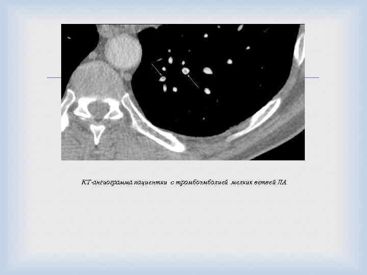  КТ-ангиограмма пациентки с тромбоэмболией мелких ветвей ЛА 