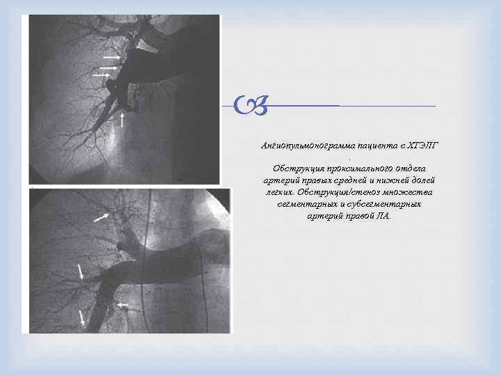  Ангиопульмонограмма пациента с ХТЭЛГ . Обструкция проксимального отдела артерий правых средней и нижней