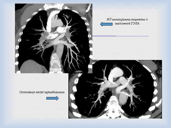 КТ-ангиограмма пациента с массивной ТЭЛА Состояние после тромболизиса 
