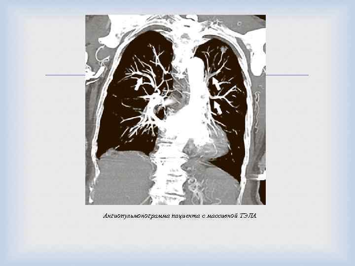  Ангиопульмонограмма пациента с массивной ТЭЛА 