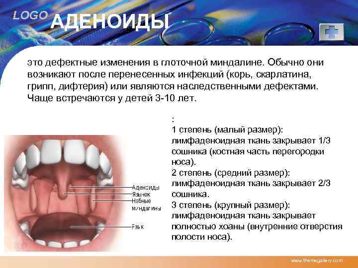 LOGO АДЕНОИДЫ это дефектные изменения в глоточной миндалине. Обычно они возникают после перенесенных инфекций