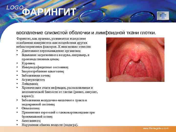 LOGO ФАРИНГИТ воспаление слизистой оболочки и лимфоидной ткани глотки. Фарингит, как правило, развивается вследствие