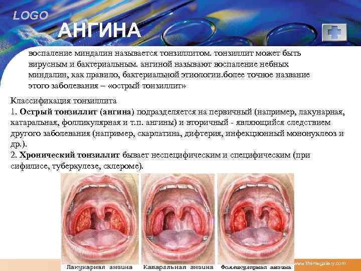 LOGO АНГИНА воспаление миндалин называется тонзиллитом. тонзиллит может быть вирусным и бактериальным. ангиной называют
