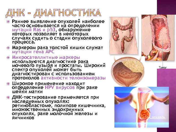  Раннее выявление опухолей наиболее часто основывается на определении мутаций Ras и p 53,