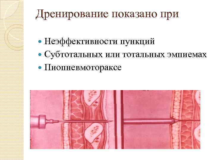 Дренирование показано при Неэффективности пункций Субтотальных или тотальных эмпиемах Пиопневмотораксе 