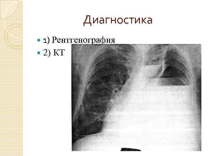 Диагностика 1) Рентгенография 2) КТ 