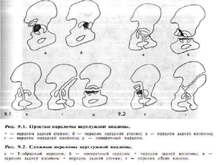 Перелом вертлужной впадины. Перелом вертлужной впадины классификация. Перелом задней стенки вертлужной впадины. Перелом дна вертлужной впадины классификация. Перелом задней колонны вертлужной впадины.