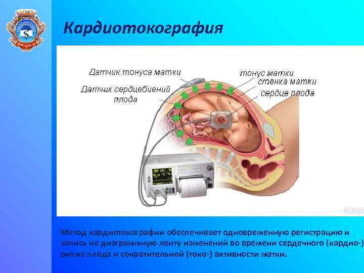 Кардиотокография Метод кардиотокографии обеспечивает одновременную регистрацию и запись на диаграммную ленту изменений во времени