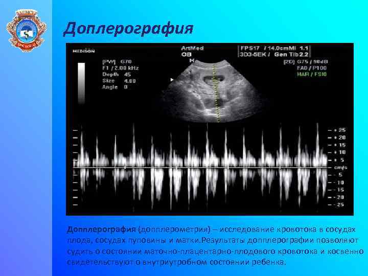 Доплерография Допплерография (допплерометрия) – исследование кровотока в сосудах плода, сосудах пуповины и матки. Результаты