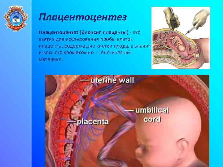 Плацентоцентез (биопсия плаценты) - это взятие для исследования пробы клеток плаценты, содержащие клетки плода,