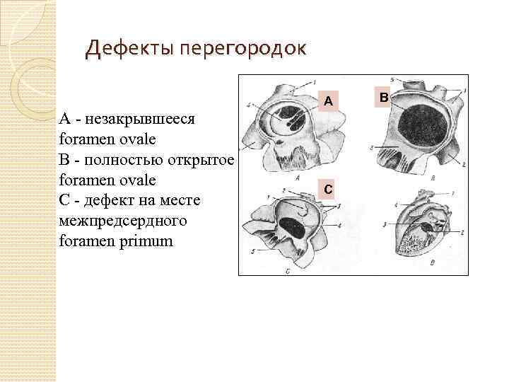 Дефекты перегородок А А - незакрывшееся foramen ovale В - полностью открытое foramen ovale