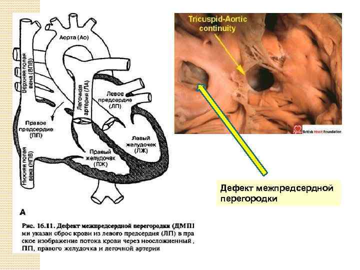 Операция межпредсердной перегородки. Дефект межпредсердной перегородки гемодинамика схема. Гемодинамика при дефекте межпредсердной перегородки. Дефект межпредсердной перегородки филогенетические предпосылки. Нарушение гемодинамики при ДМПП.