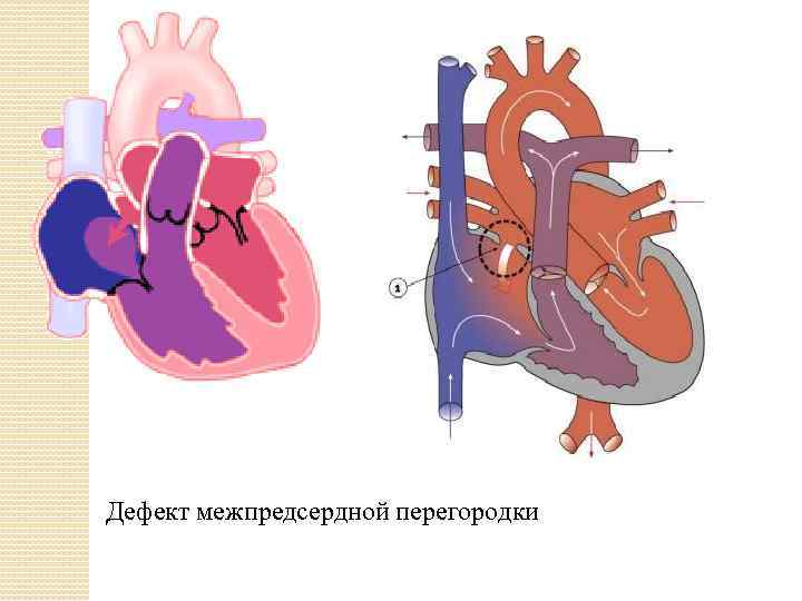 Операция межпредсердной перегородки. Дефект межпредсердной перегородки. Вторичный дефект межпредсердной перегородки. Незаращение межпредсердной перегородки. Дефект межпредсердной перегородки гемодинамика.