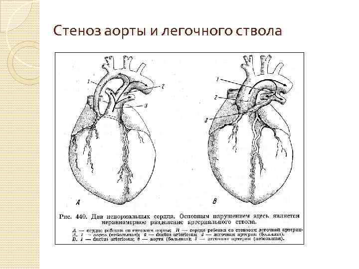 Стеноз аорты и легочного ствола 