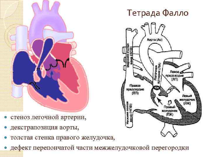 Тетрада Фалло стеноз легочной артерии, декстрапозиция аорты, толстая стенка правого желудочка, дефект перепончатой части