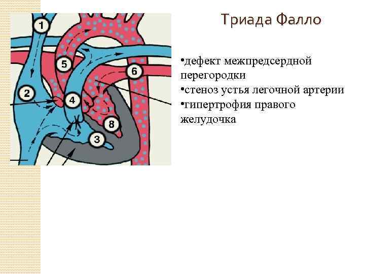 Триада Фалло • дефект межпредсердной перегородки • стеноз устья легочной артерии • гипертрофия правого