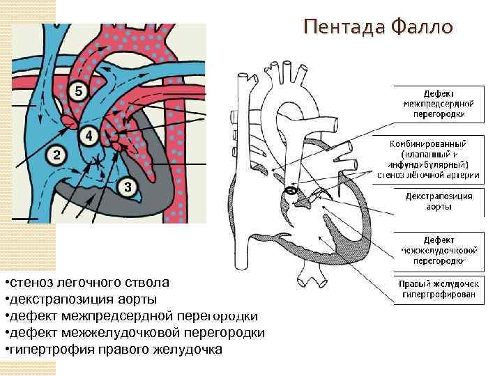 Пентада Фалло • стеноз легочного ствола • декстрапозиция аорты • дефект межпредсердной перегородки •