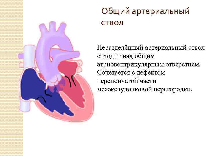 Общий артериальный ствол Неразделённый артериальный ствол отходит над общим атриовентрикулярным отверстием. Сочетается с дефектом